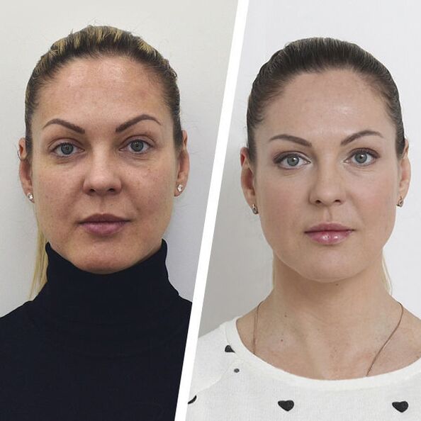 Avant et après le rajeunissement de la peau du visage sans chirurgie.