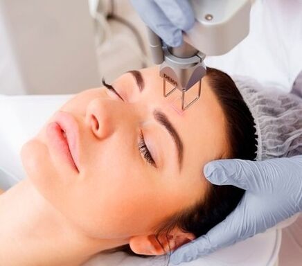 L'essence de la procédure de rajeunissement de la peau du visage avec un laser fractionné.