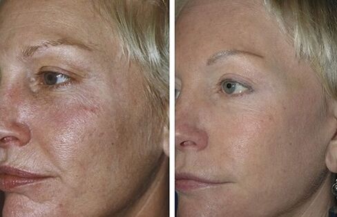 resurfaçage fractionné au laser photos avant et après