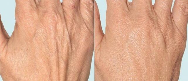 Peau des mains avant et après la thérapie fractionnée.