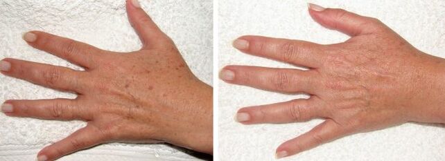 Résultat de l'élimination des taches pigmentaires sur les mains.