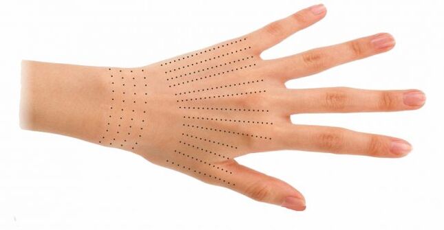 Sites d'injection pour les mains lors de la bio-revitalisation.