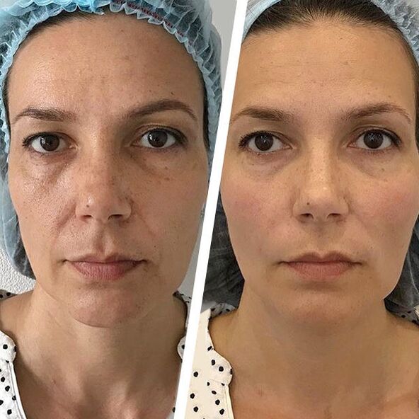 photo du visage avant et après resurfaçage laser